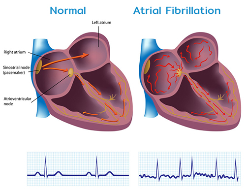 Atrial Fibrillation
