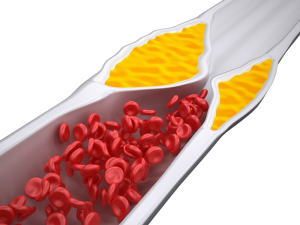 narrowed artery