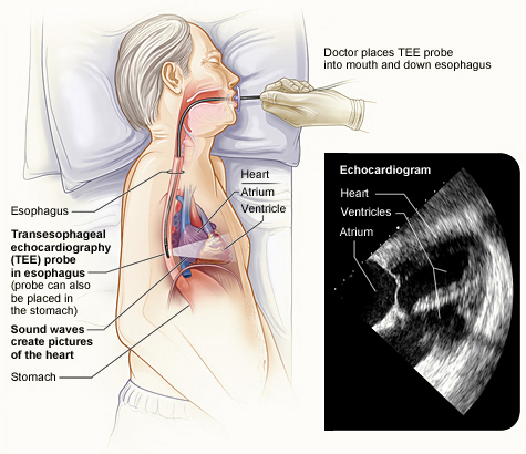 transesophageal echocardiography procedure